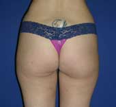 ΛΙΠΟΑΝΑΡΡΟΦΗΣΗ, ΛΙΠΟΓΛΥΠΤΙΚΗ, ΛΙΠΟΑΝΑΚΥΚΛΩΣΗ, ΛΙΠΟΑΝΑΡΡΟΦΗΣΗ ΚΟΙΛΙΑΣ, ΚΟΣΤΟΣ, ΘΕΣΣΑΛΟΝΙΚΗ, ΤΙΜΕΣ, ΤΙΜΗ, ΛΕΙΣΕΡ, ΜΕ LASER, ΓΥΝΑΙΚΟΜΑΣΤΙΑ, ΓΛΟΥΤΩΝ, ΓΛΟΥΤΟΙ, ΦΩΤΟΓΡΑΦΙΕΣ, ΓΑΜΠΕΣ, ΣΩΜΑΤΟΣ, ΠΡΟΣΩΠΟΥ, ΠΛΑΣΤΙΚΗ ΧΕΙΡΟΥΡΓΙΚΗ ΣΤΟΥΣ ΑΝΔΡΕΣ, ΠΛΑΣΤΙΚΟΣ ΧΕΙΡΟΥΡΓΟΣ, ΑΘΗΝΑ, ΠΛΑΣΤΙΚΟΙ ΧΕΙΡΟΥΡΓΟΙ, ΑΝΔΡΙΚΟ ΣΤΗΘΟΣ, ΑΙΣΘΗΤΙΚΗ ΠΛΑΣΤΙΚΗ ΧΕΙΡΟΥΡΓΙΚΗ, ΛΙΠΟΣ, ΠΑΧΥΣΑΡΚΙΑ